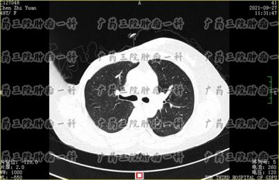 乳腺结节离乳腺癌究竟有多远?