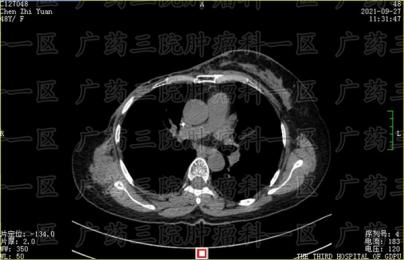 乳腺癌可以做粒子植入吗?