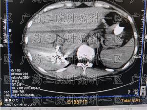 哪些癌症患者不建议进行化疗？