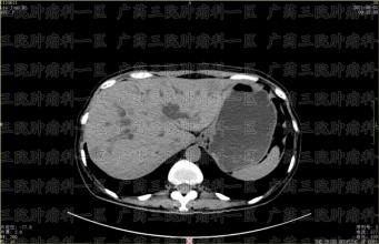 胰腺癌患者转院前，被医生宣判活不过三个月