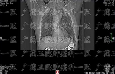 根治术等于食管癌根.治吗?