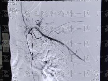 热疗对乳腺癌有作用吗?