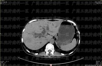 因感染新冠而不得不延迟治疗会影响疗效吗？