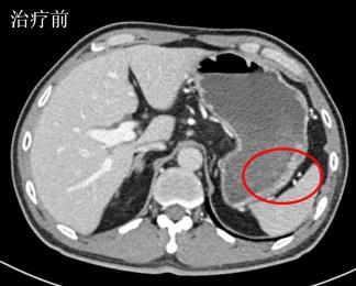 跨越三千多公里，胃癌患者直呼：在广州获得