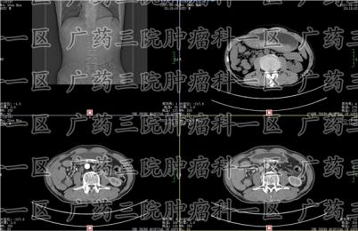 肇庆肿瘤患者在广州胃肿瘤医院怎么治好